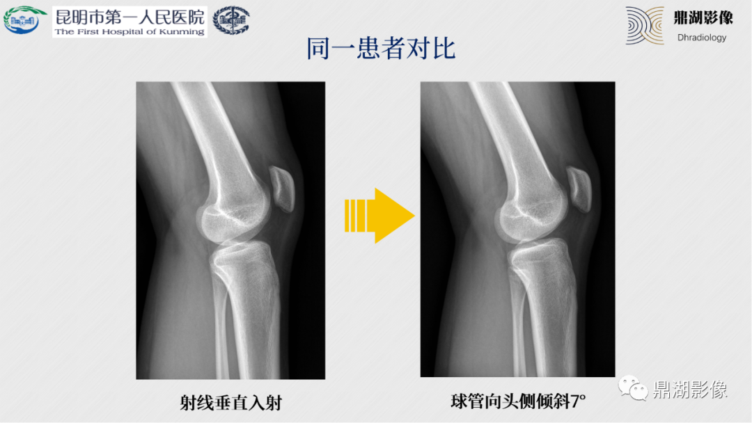 影像PPT - 【PPT】膝关节X线摄片技术改进-40