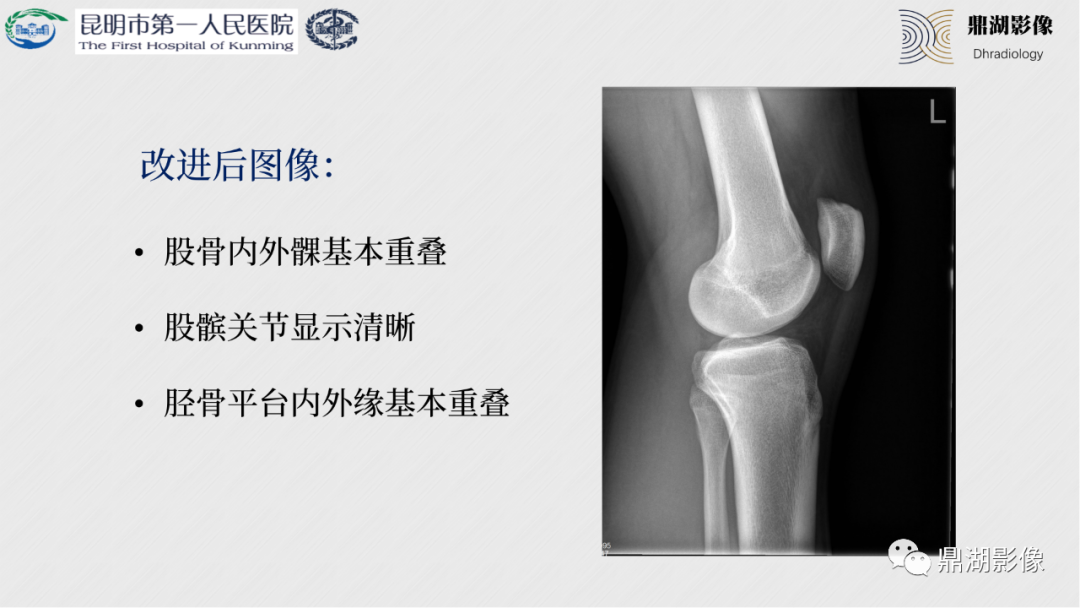影像PPT - 【PPT】膝关节X线摄片技术改进-41