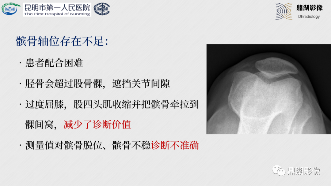 影像PPT - 【PPT】膝关节X线摄片技术改进-47