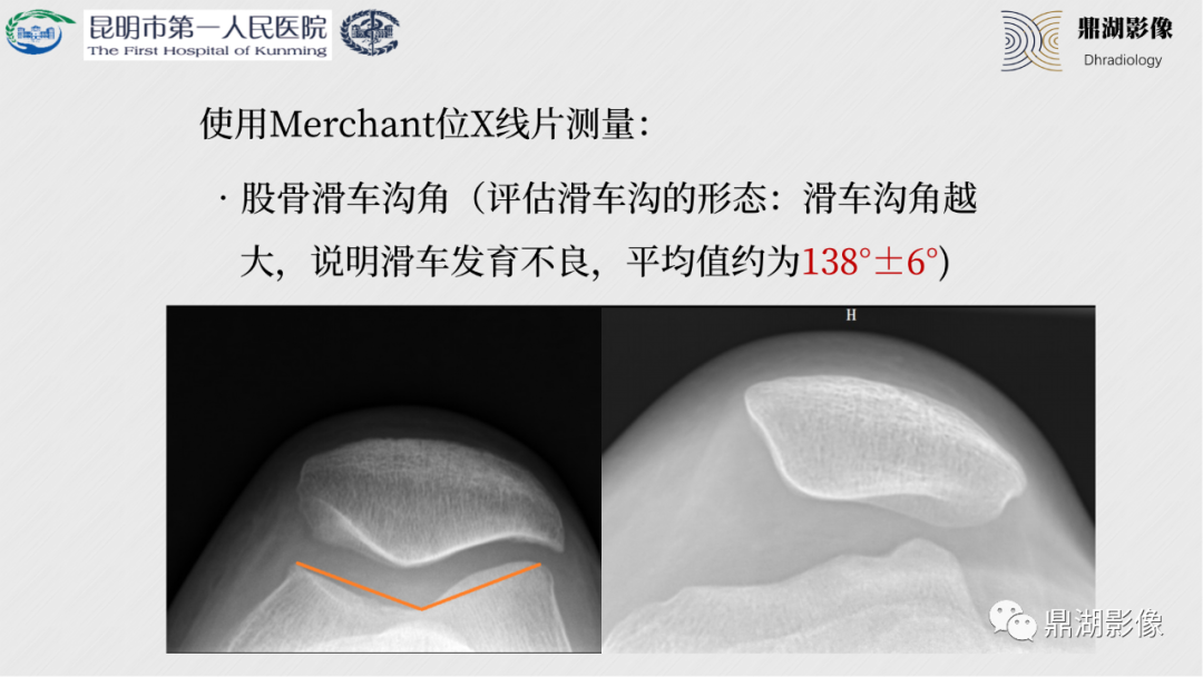 影像PPT - 【PPT】膝关节X线摄片技术改进-54