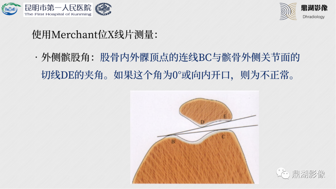 影像PPT - 【PPT】膝关节X线摄片技术改进-56