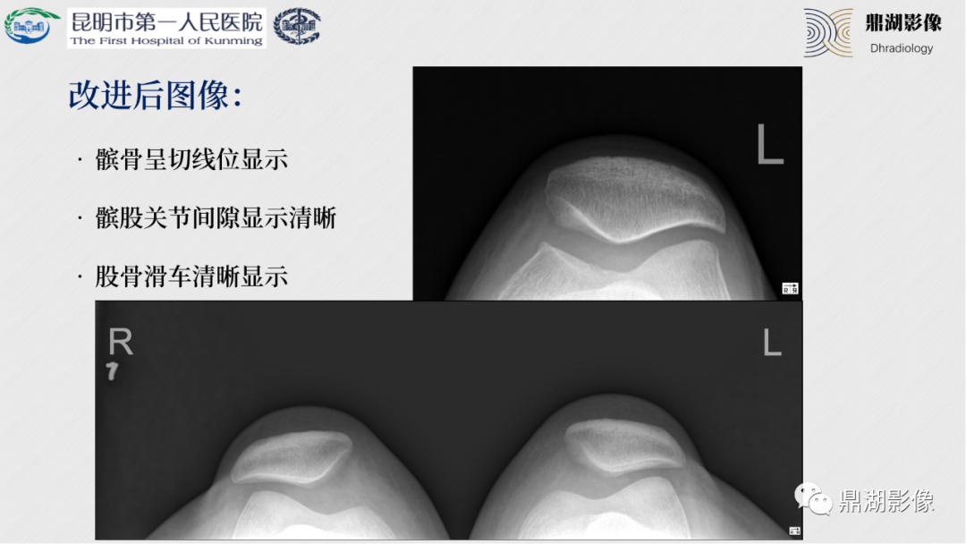 影像PPT - 【PPT】膝关节X线摄片技术改进-57