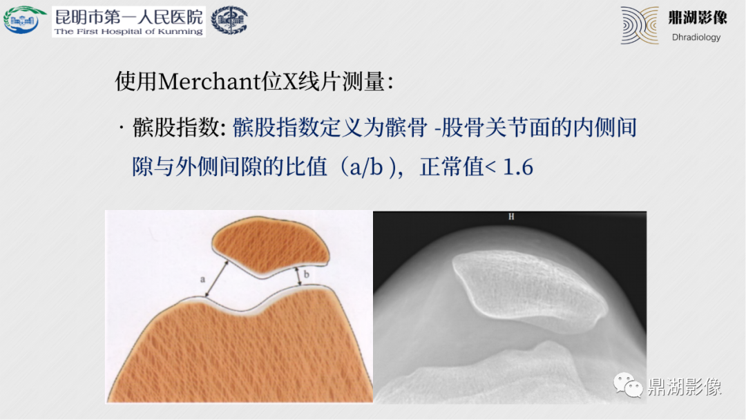 影像PPT - 【PPT】膝关节X线摄片技术改进-55