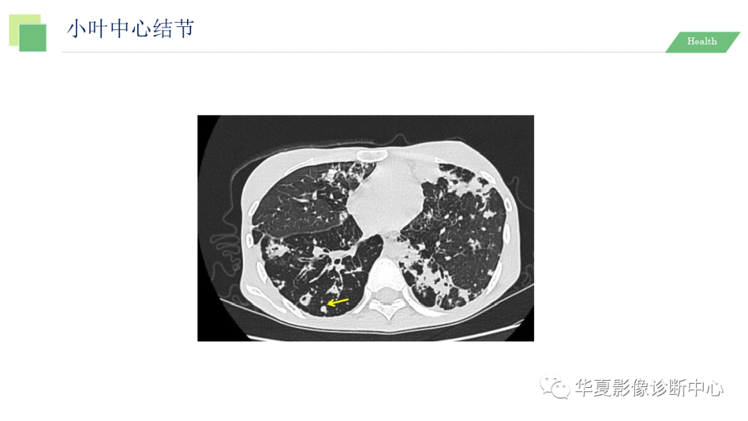 影像PPT - 【PPT】活动性肺结核抗结核治疗疗效的影像学评价-15
