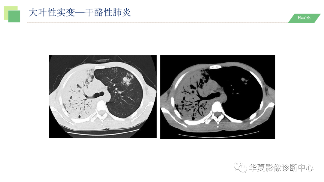 影像PPT - 【PPT】活动性肺结核抗结核治疗疗效的影像学评价-17