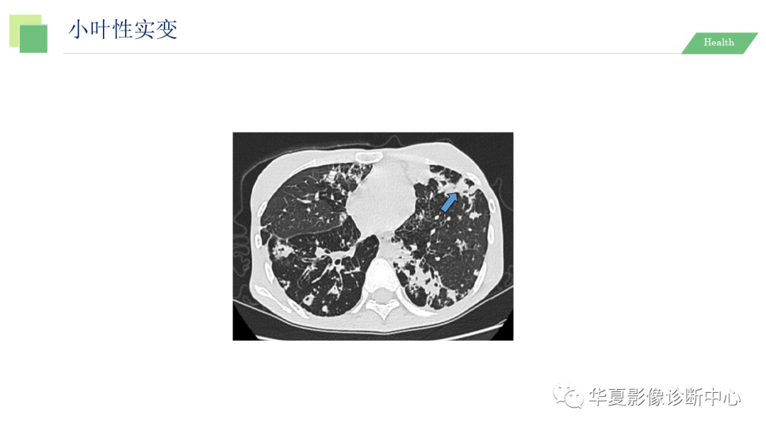 影像PPT - 【PPT】活动性肺结核抗结核治疗疗效的影像学评价-19