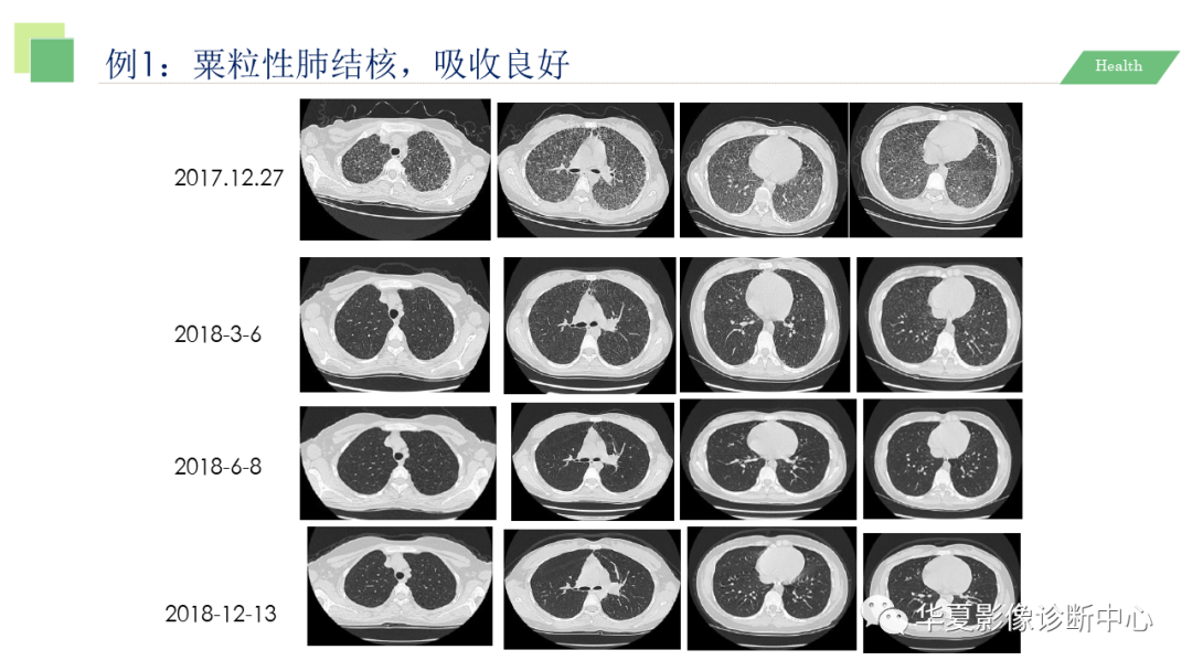 影像PPT - 【PPT】活动性肺结核抗结核治疗疗效的影像学评价-44