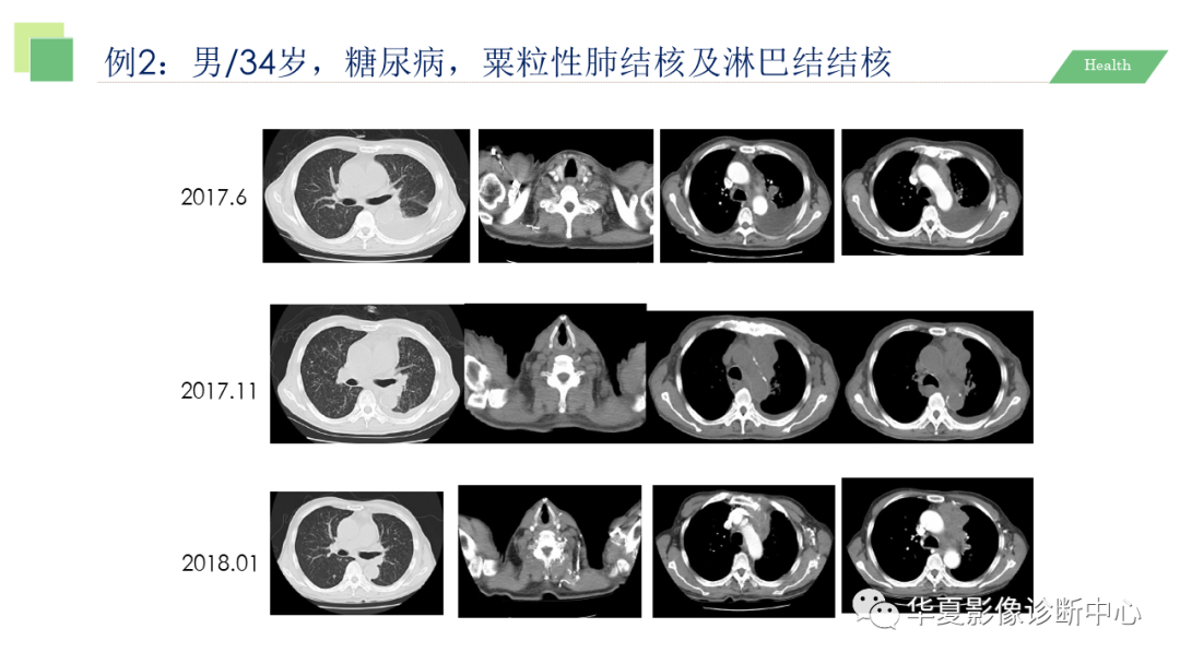 影像PPT - 【PPT】活动性肺结核抗结核治疗疗效的影像学评价-45