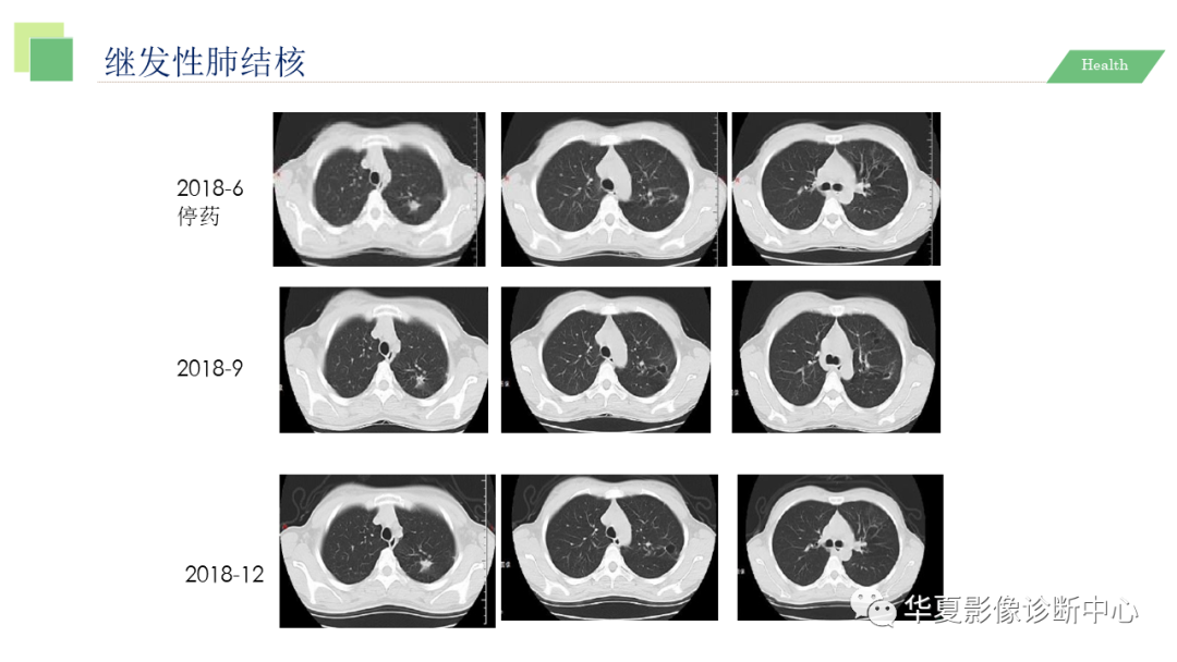 影像PPT - 【PPT】活动性肺结核抗结核治疗疗效的影像学评价-48