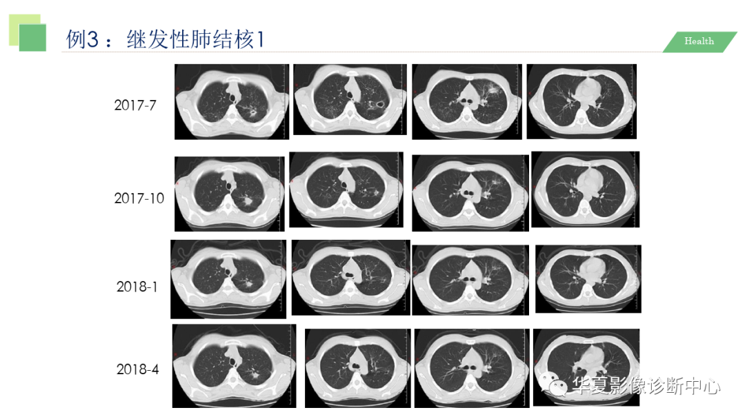 影像PPT - 【PPT】活动性肺结核抗结核治疗疗效的影像学评价-47