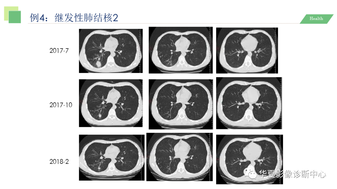 影像PPT - 【PPT】活动性肺结核抗结核治疗疗效的影像学评价-49