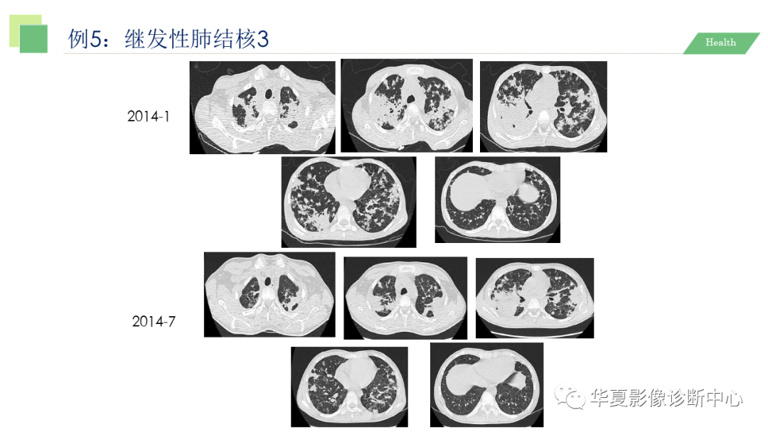 影像PPT - 【PPT】活动性肺结核抗结核治疗疗效的影像学评价-51