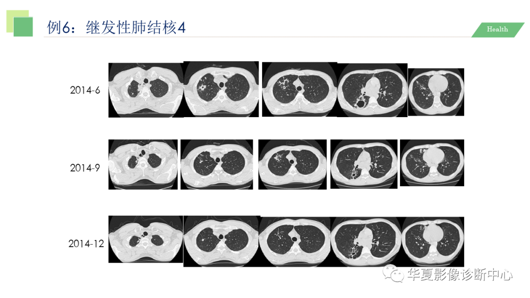 影像PPT - 【PPT】活动性肺结核抗结核治疗疗效的影像学评价-53
