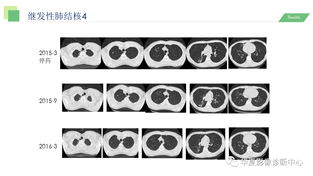 影像PPT - 【PPT】活动性肺结核抗结核治疗疗效的影像学评价-54