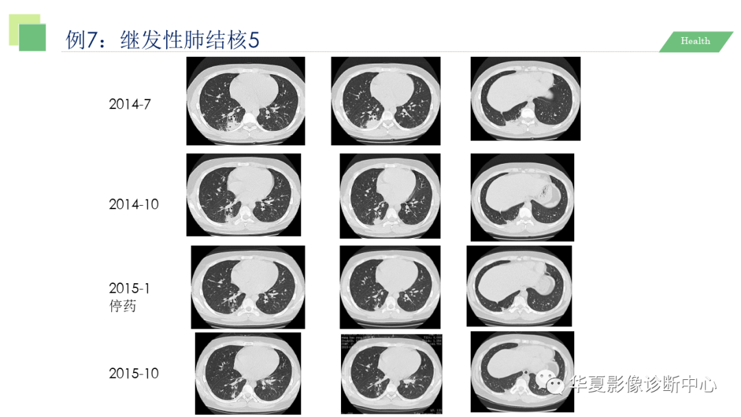 影像PPT - 【PPT】活动性肺结核抗结核治疗疗效的影像学评价-55