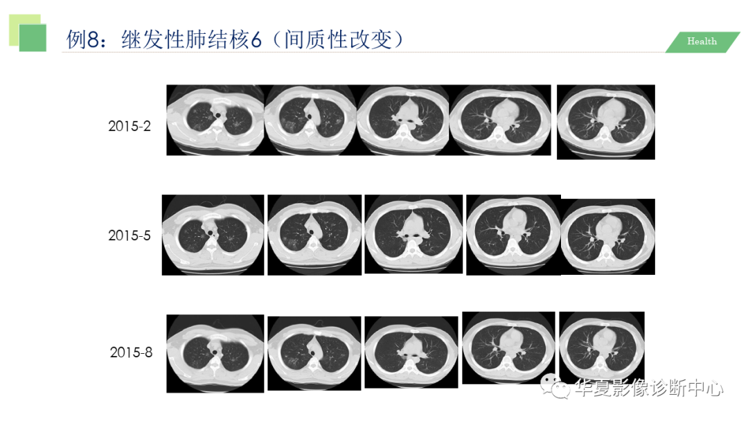 影像PPT - 【PPT】活动性肺结核抗结核治疗疗效的影像学评价-56
