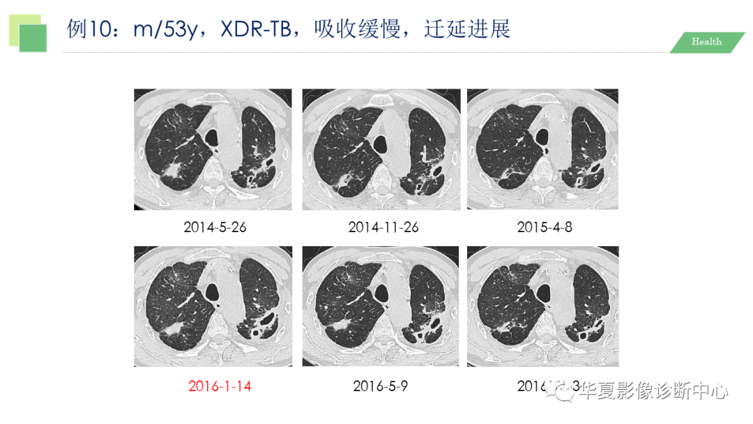 影像PPT - 【PPT】活动性肺结核抗结核治疗疗效的影像学评价-59