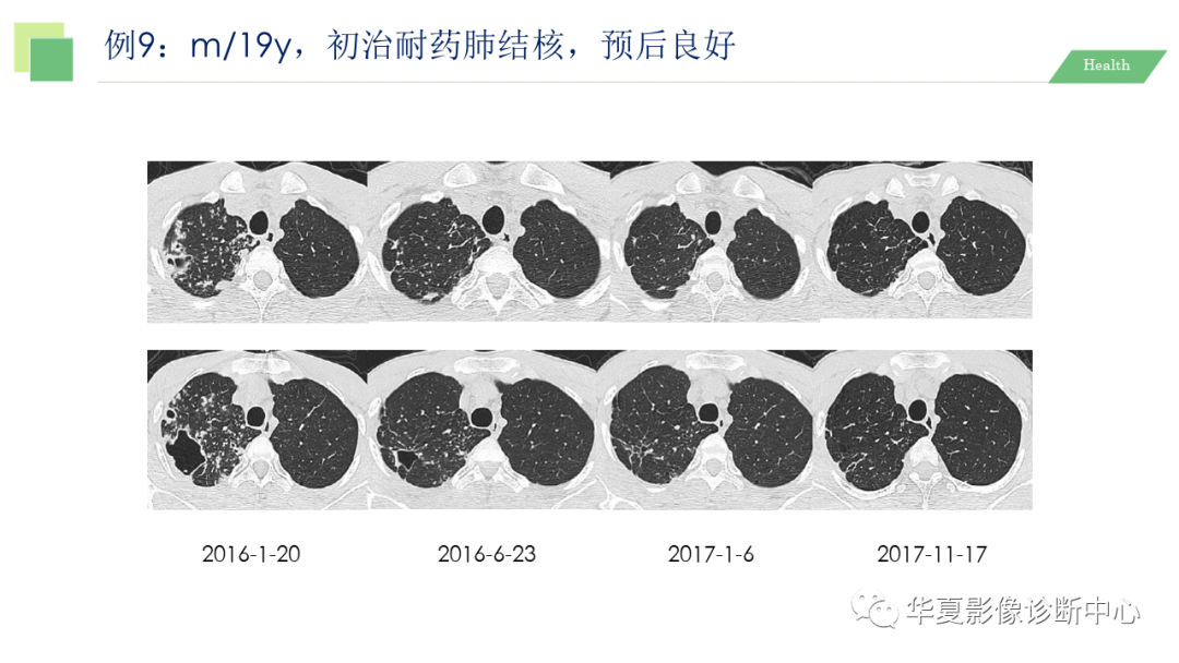 影像PPT - 【PPT】活动性肺结核抗结核治疗疗效的影像学评价-58