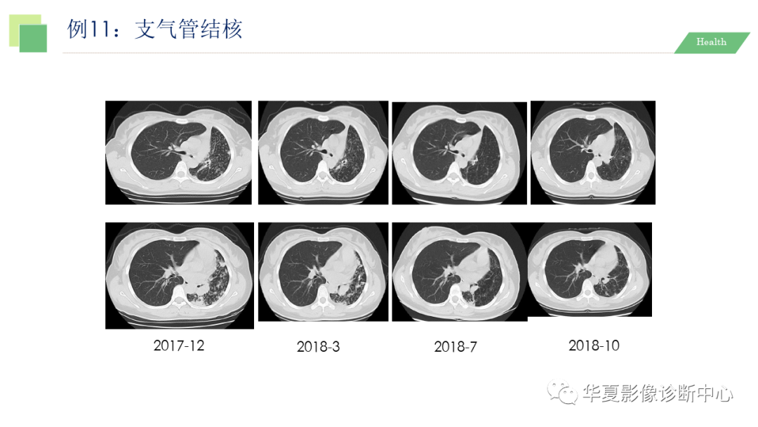 影像PPT - 【PPT】活动性肺结核抗结核治疗疗效的影像学评价-63
