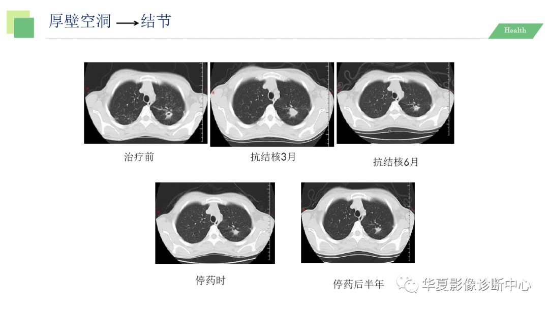 影像PPT - 【PPT】活动性肺结核抗结核治疗疗效的影像学评价-68
