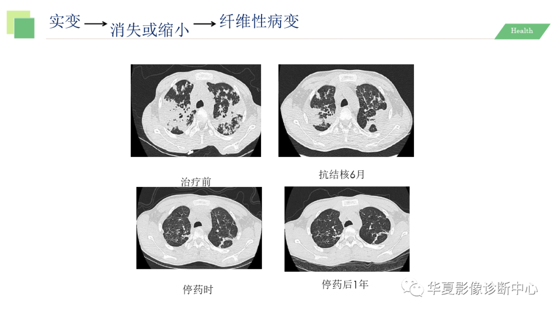 影像PPT - 【PPT】活动性肺结核抗结核治疗疗效的影像学评价-69