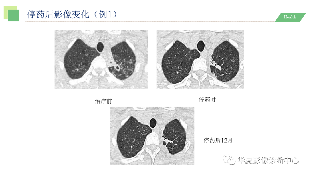 影像PPT - 【PPT】活动性肺结核抗结核治疗疗效的影像学评价-71