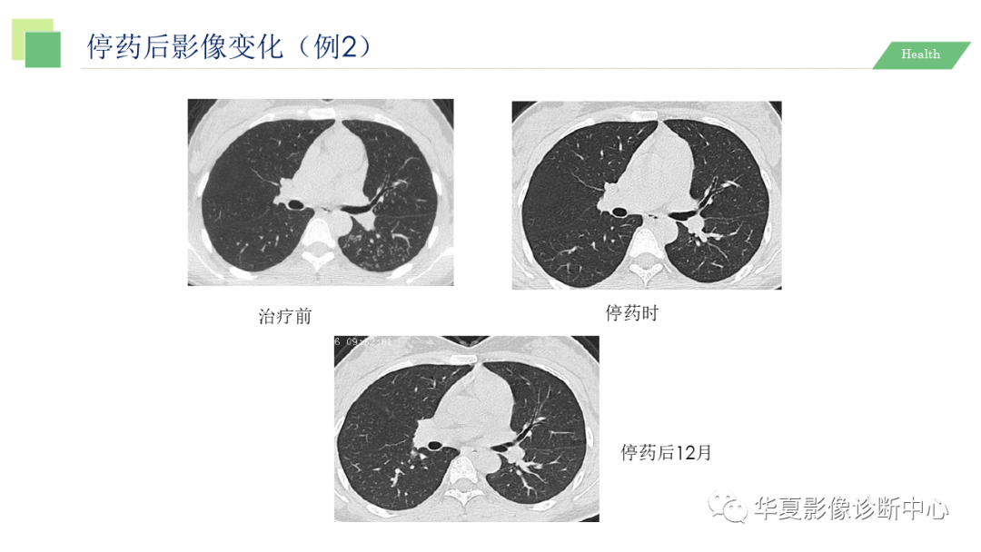 影像PPT - 【PPT】活动性肺结核抗结核治疗疗效的影像学评价-72