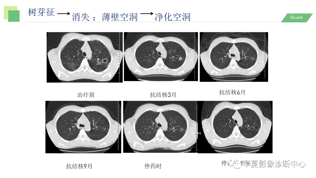 影像PPT - 【PPT】活动性肺结核抗结核治疗疗效的影像学评价-70