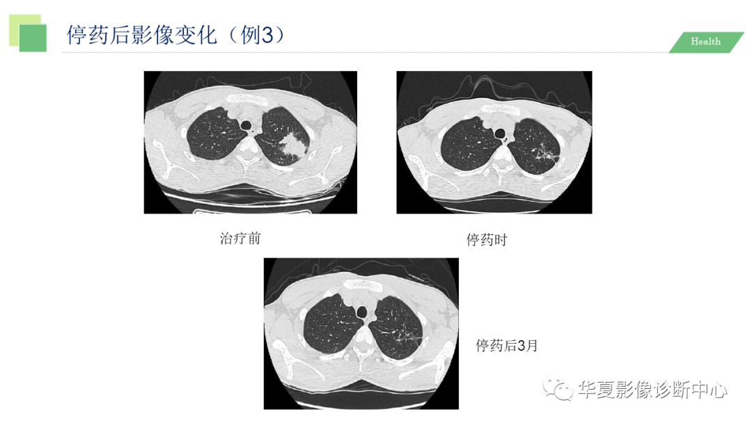影像PPT - 【PPT】活动性肺结核抗结核治疗疗效的影像学评价-73