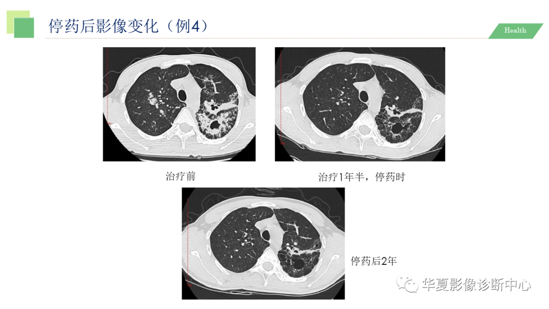 影像PPT - 【PPT】活动性肺结核抗结核治疗疗效的影像学评价-74