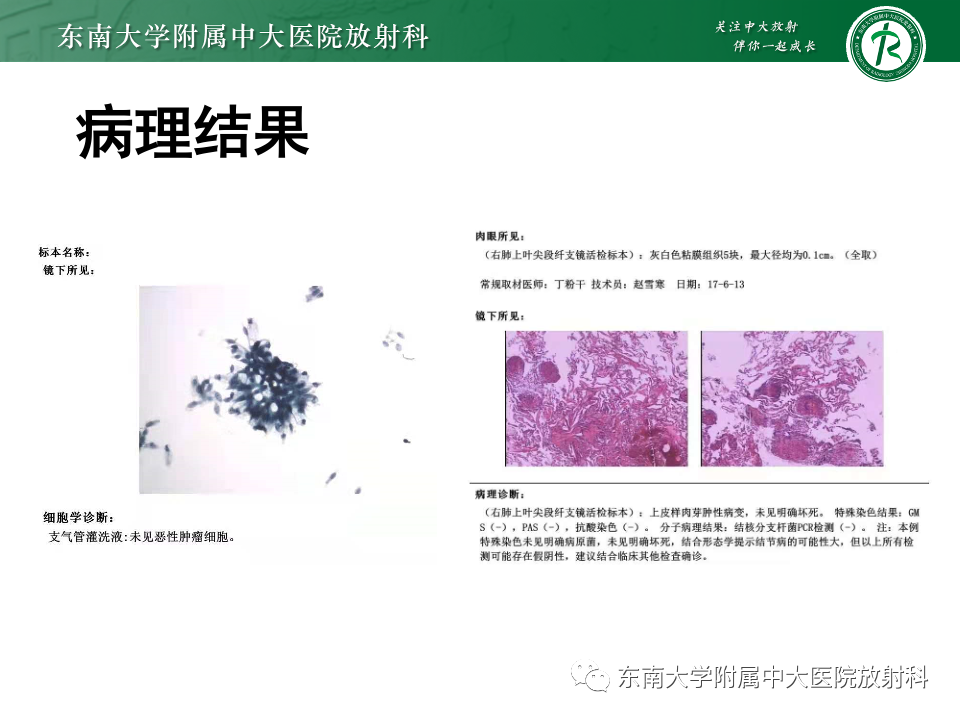 影像PPT - 【PPT】肺淋巴管周围结节-3