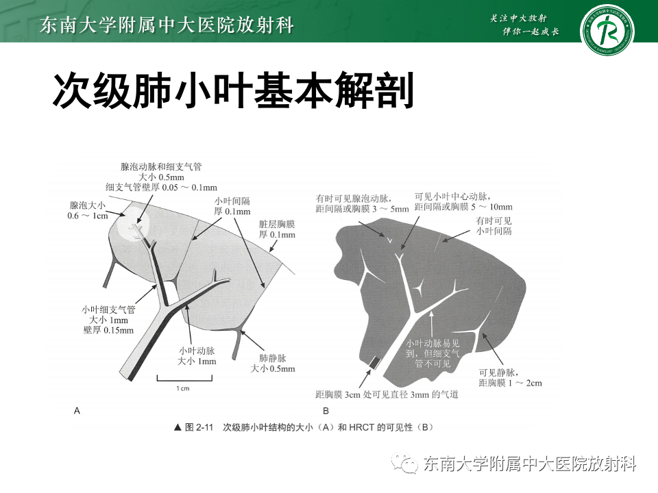 影像PPT - 【PPT】肺淋巴管周围结节-7