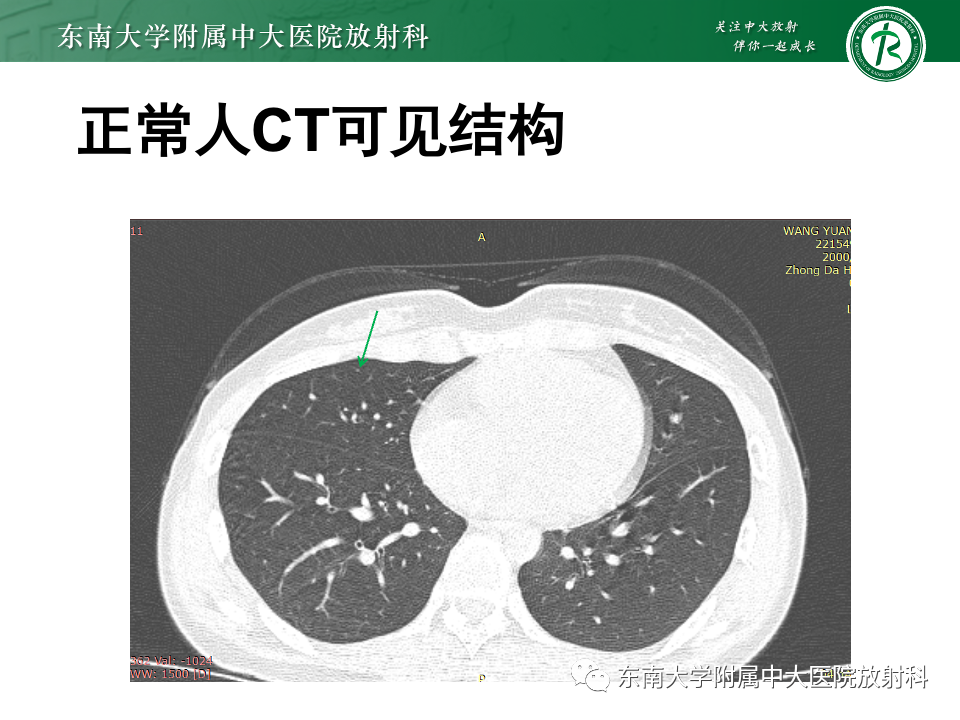 影像PPT - 【PPT】肺淋巴管周围结节-9
