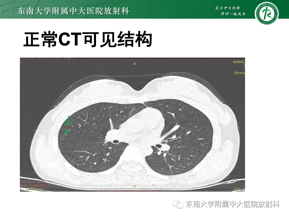 影像PPT - 【PPT】肺淋巴管周围结节-8
