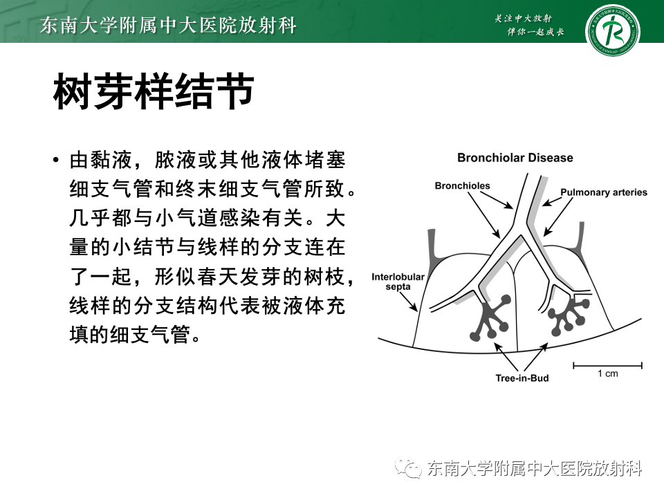 影像PPT - 【PPT】肺淋巴管周围结节-16