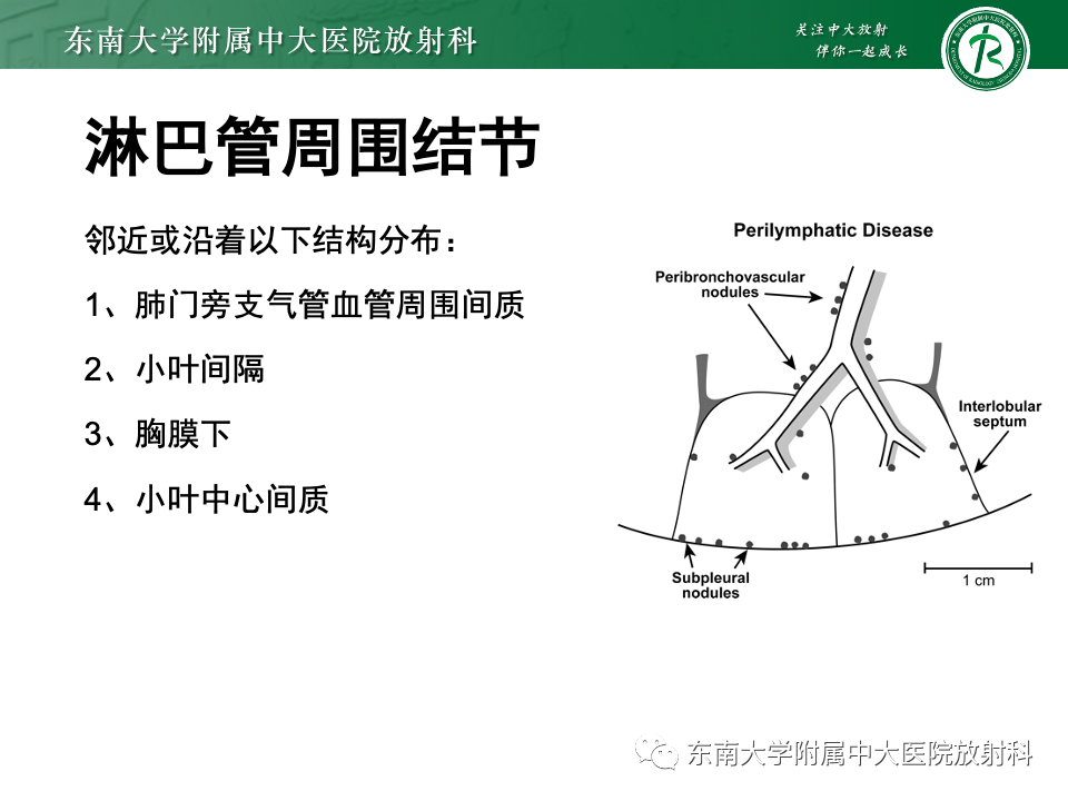 影像PPT - 【PPT】肺淋巴管周围结节-18