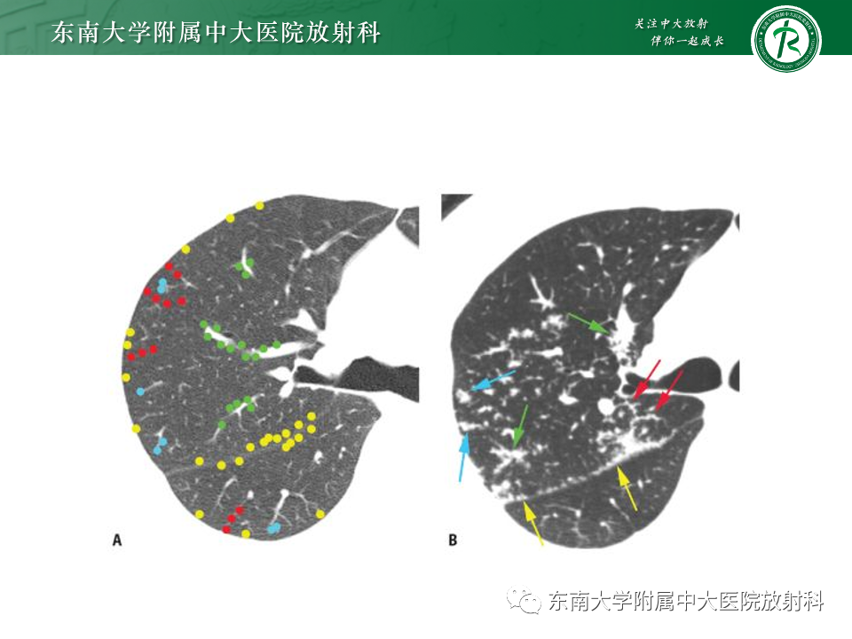 影像PPT - 【PPT】肺淋巴管周围结节-19