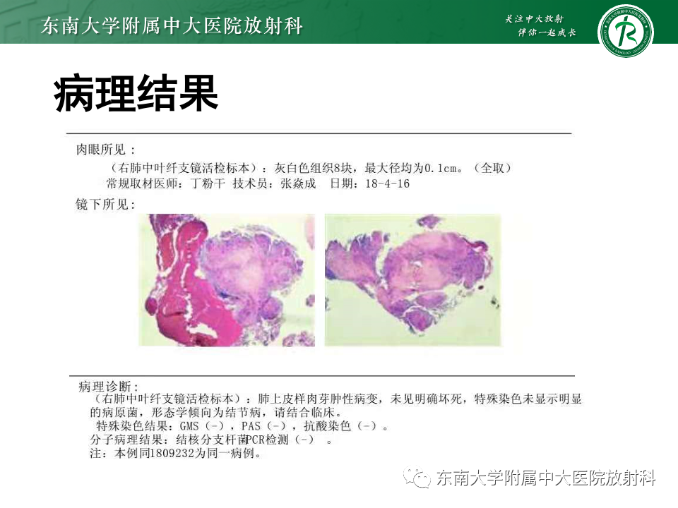 影像PPT - 【PPT】肺淋巴管周围结节-22