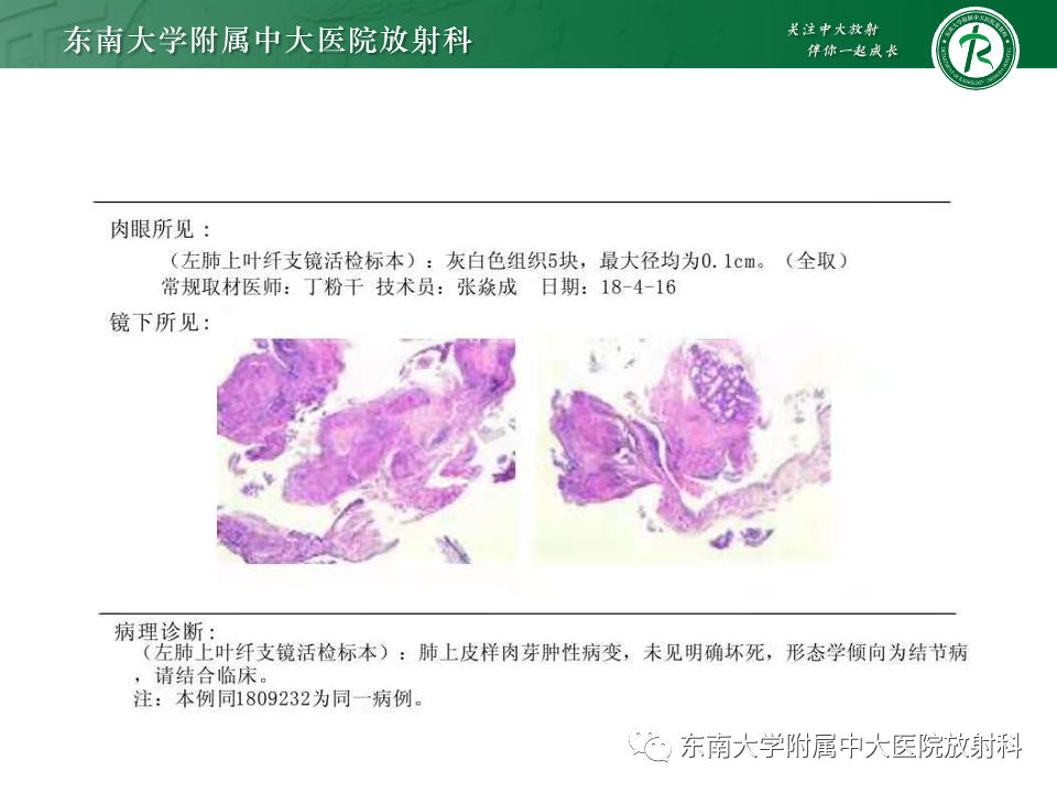 影像PPT - 【PPT】肺淋巴管周围结节-23
