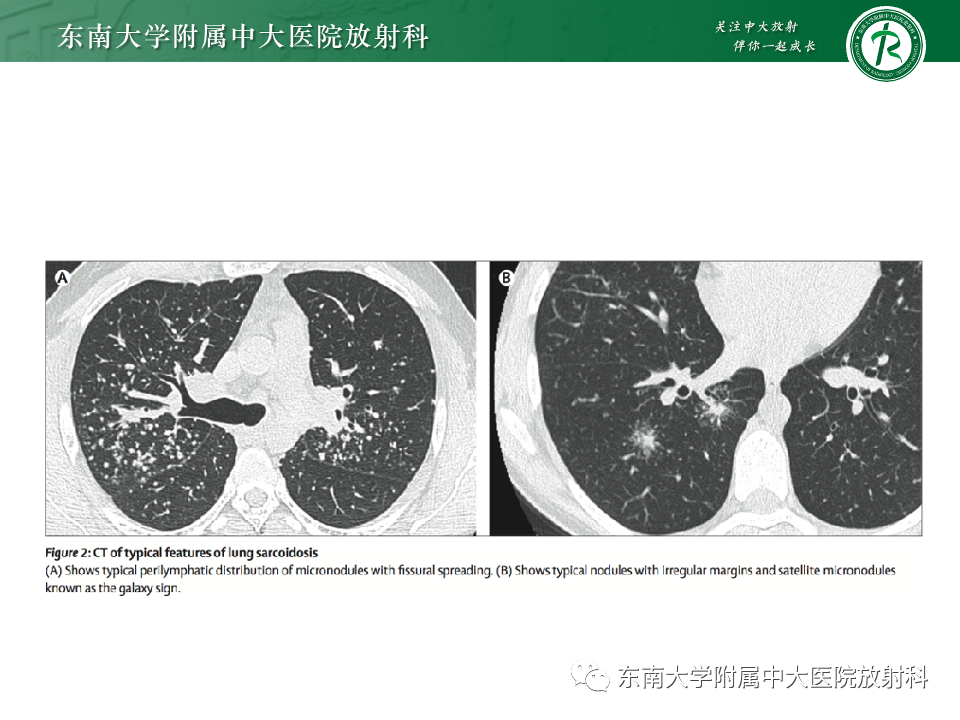 影像PPT - 【PPT】肺淋巴管周围结节-30