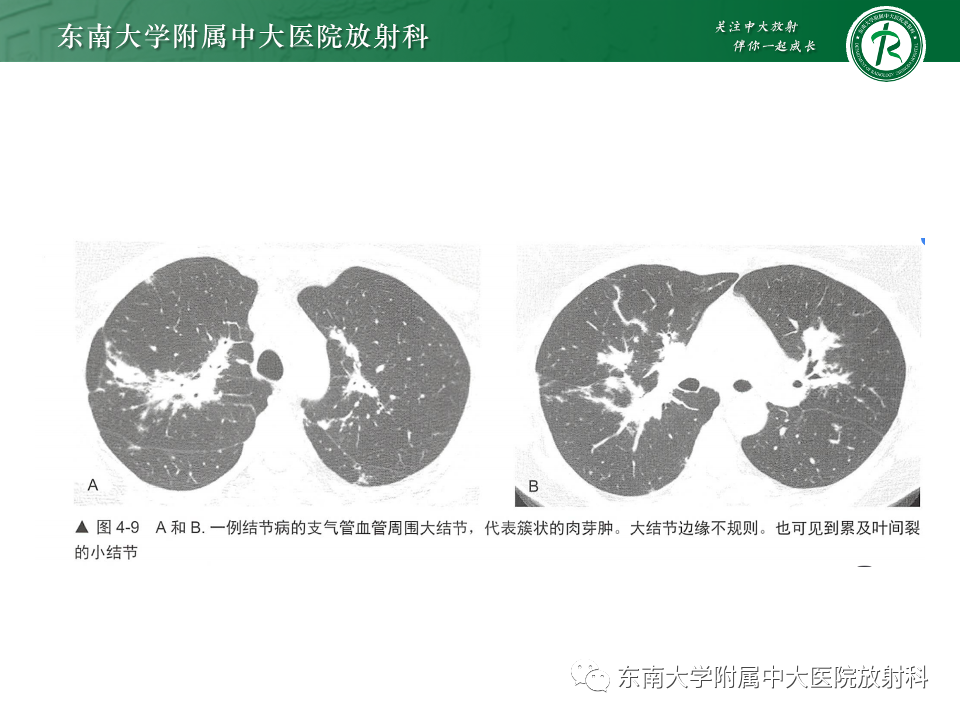 影像PPT - 【PPT】肺淋巴管周围结节-32