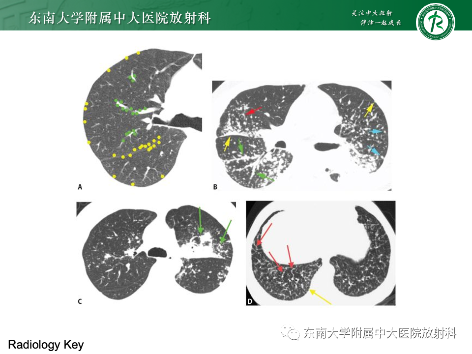 影像PPT - 【PPT】肺淋巴管周围结节-33