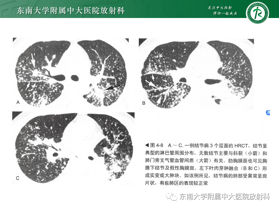 影像PPT - 【PPT】肺淋巴管周围结节-31