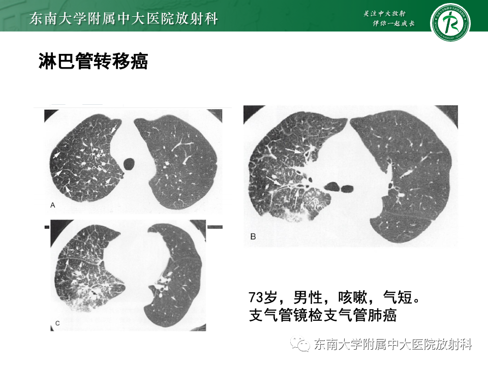 影像PPT - 【PPT】肺淋巴管周围结节-39