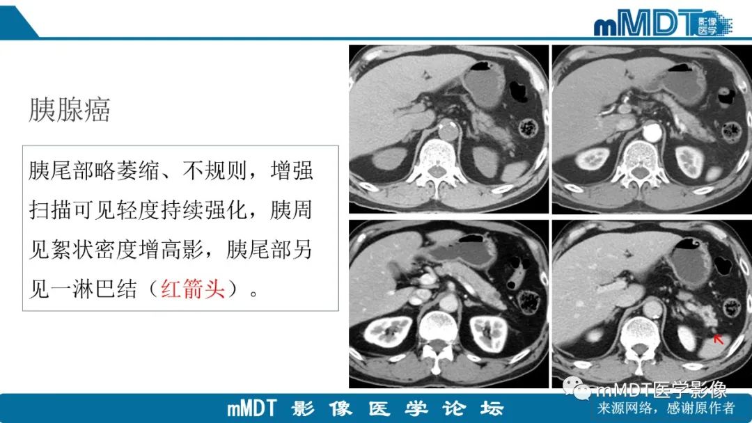 影像PPT - 【PPT】胰尾部副脾病例赏析-12 影像PPT - 【PPT】胰尾部副脾病例赏析-12