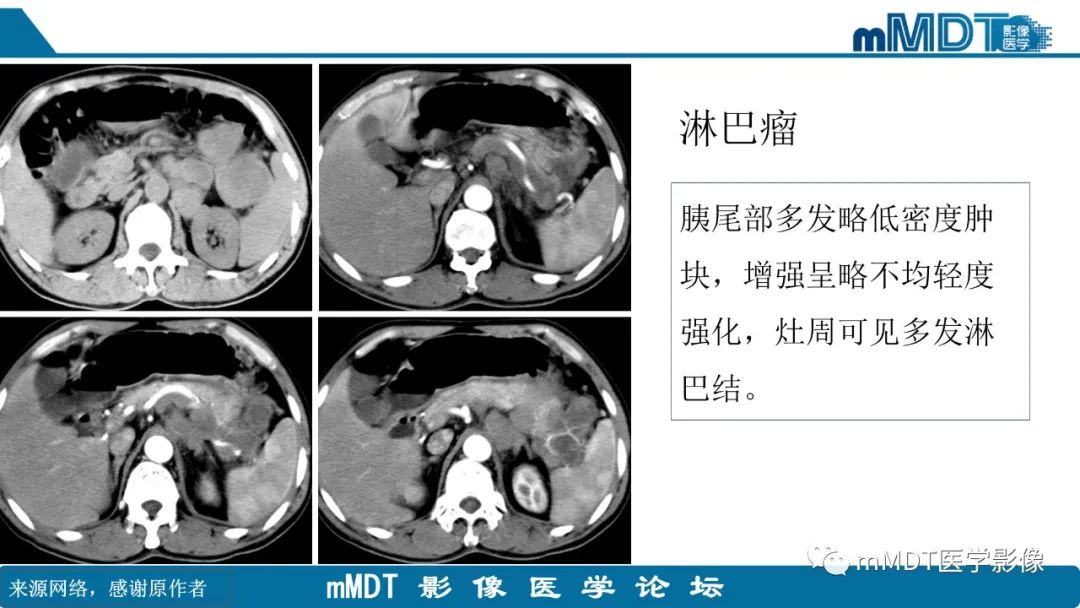 影像PPT - 【PPT】胰尾部副脾病例赏析-14 影像PPT - 【PPT】胰尾部副脾病例赏析-14