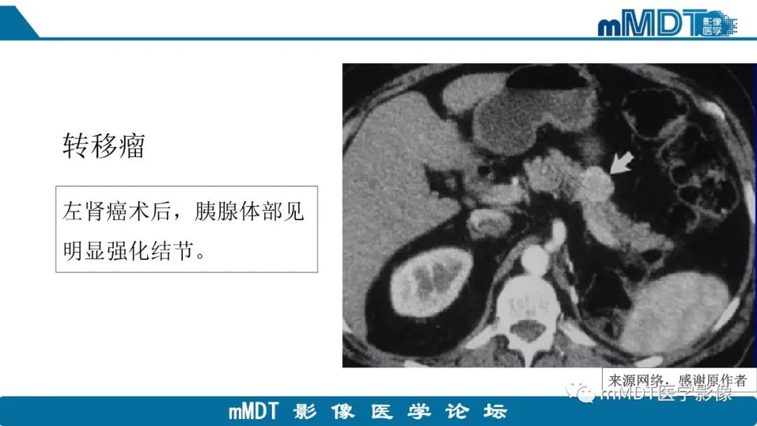 影像PPT - 【PPT】胰尾部副脾病例赏析-16 影像PPT - 【PPT】胰尾部副脾病例赏析-16