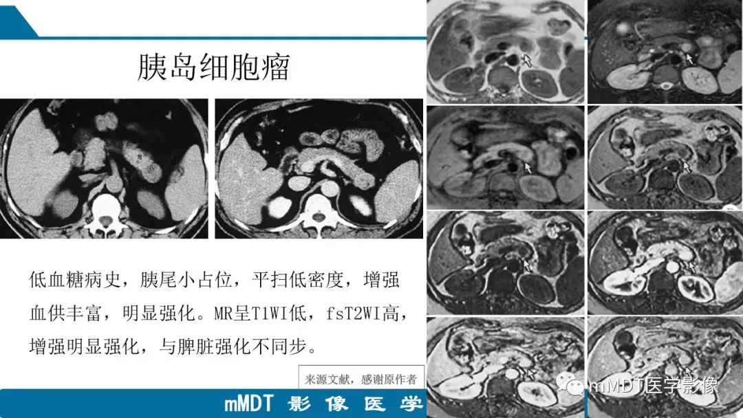 影像PPT - 【PPT】胰尾部副脾病例赏析-18 影像PPT - 【PPT】胰尾部副脾病例赏析-18