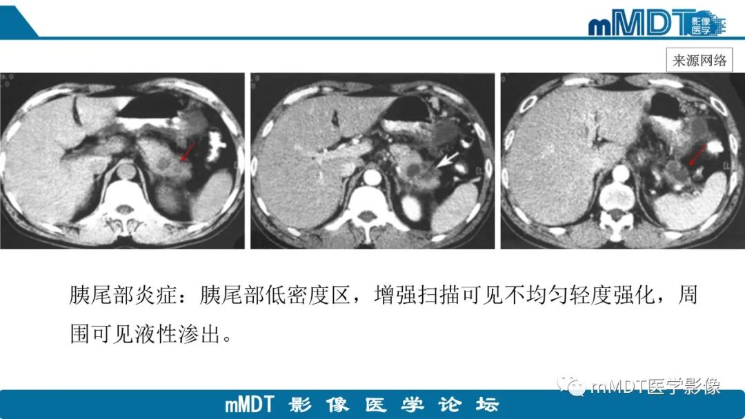 影像PPT - 【PPT】胰尾部副脾病例赏析-20 影像PPT - 【PPT】胰尾部副脾病例赏析-20