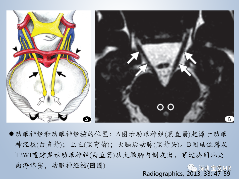 影像PPT - 【PPT】眼球运动障碍影像诊断-8